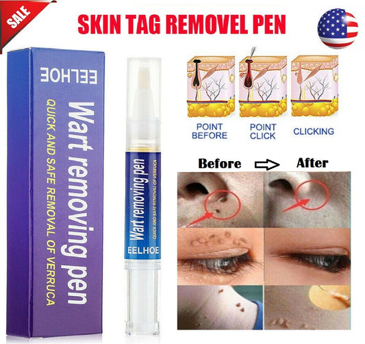 Painless Wart Remover Pen Eliminate Skin Tag Foot Corn Mole Warts Restoration US