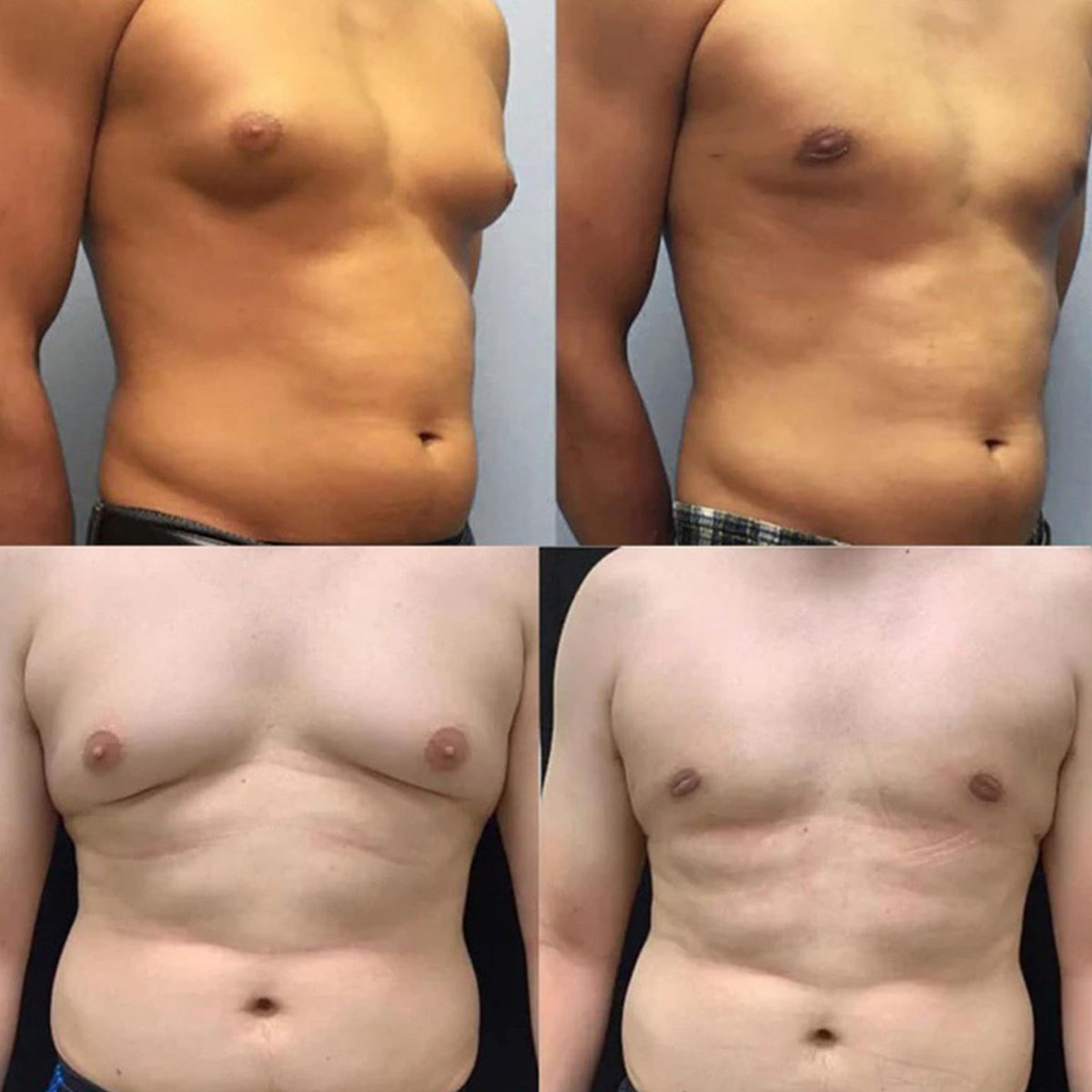 Bee Venom Gynecomastia Oil,Chest Muscles for Strengthen The Chest Muscles