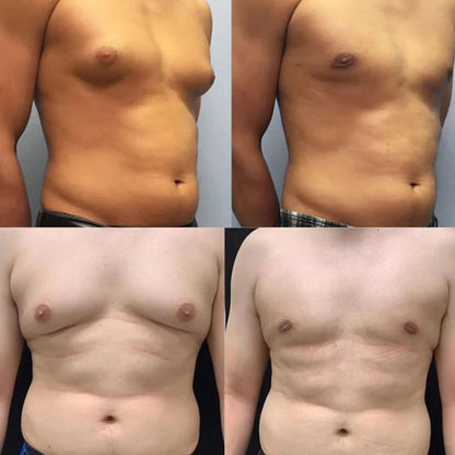 Bee Venom Gynecomastia Oil,Chest Muscles for Strengthen The Chest Muscles
