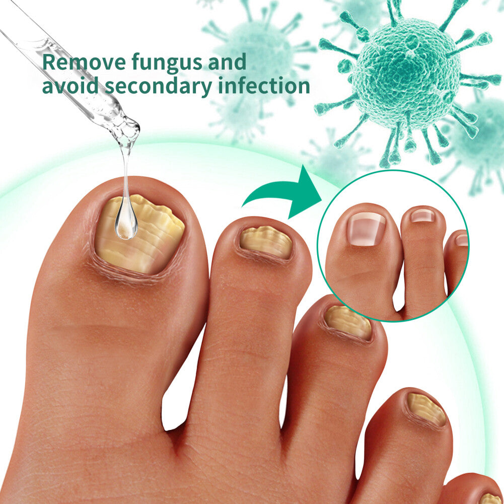1-10PCS New Kerassentials Toenail Treatment Oil, Kerassentials for Toenail US
