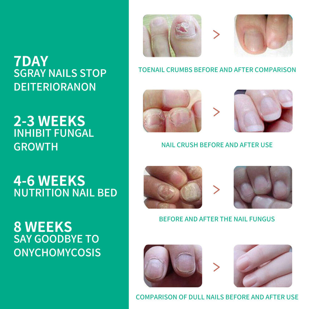 1-10PCS New Kerassentials Toenail Treatment Oil, Kerassentials for Toenail US