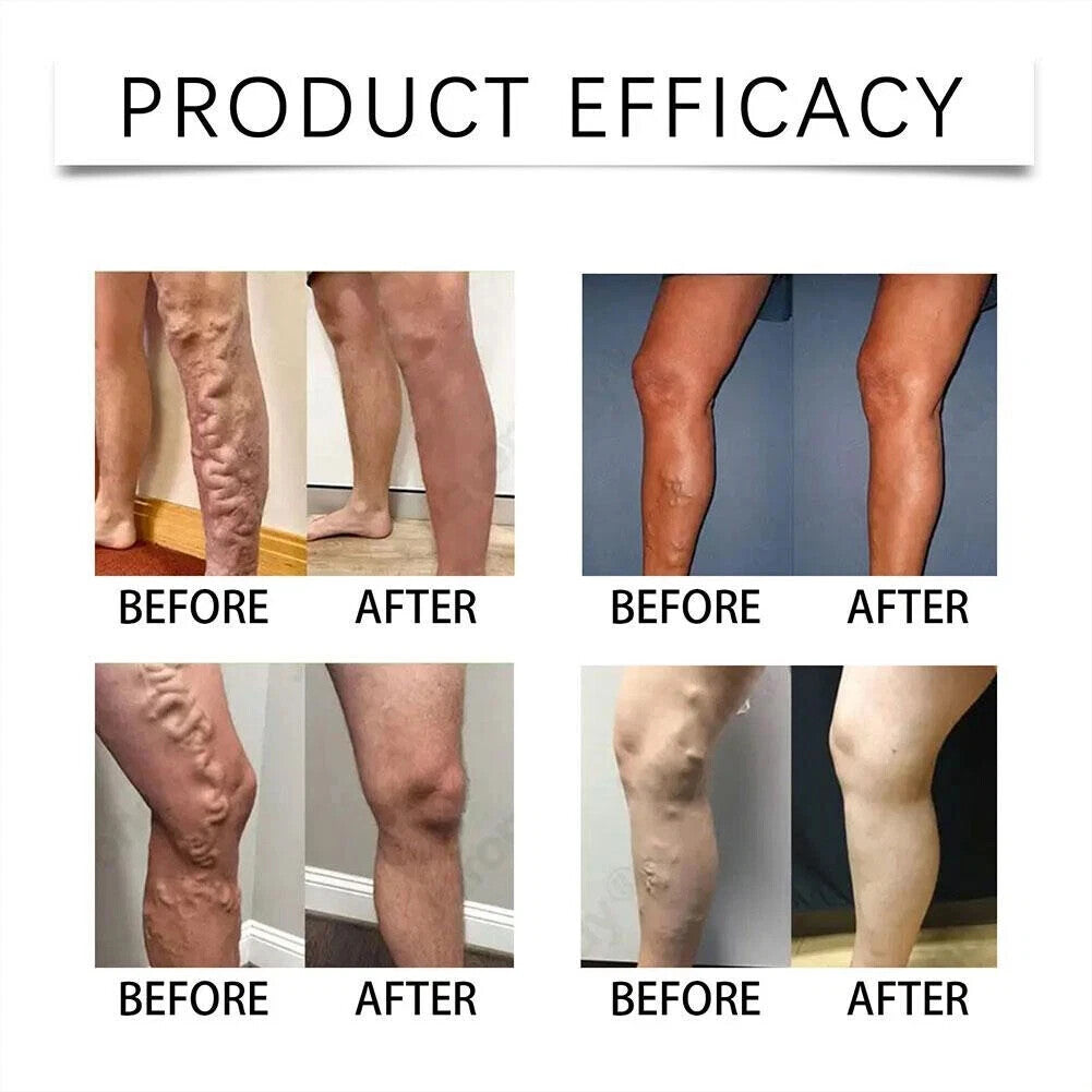 Varicose Vein Microneedle Patch Relieve Leg Swelling External Invisible Patch